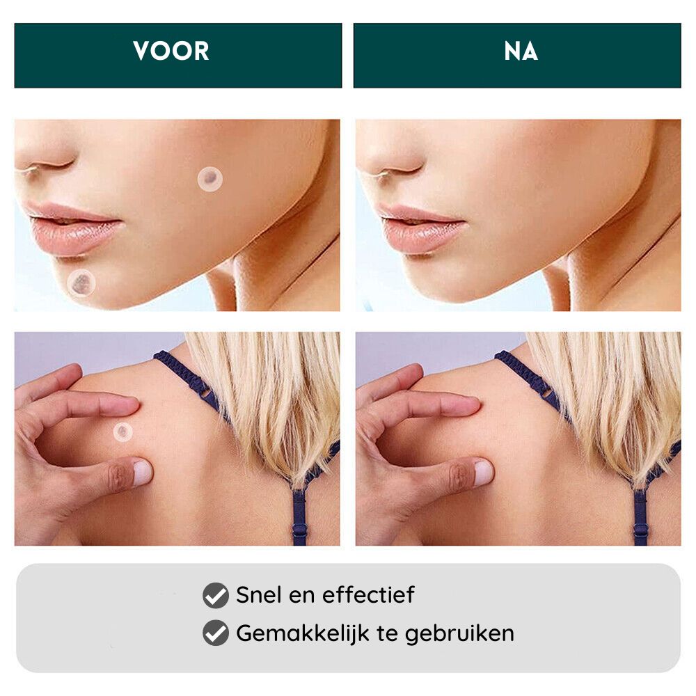 Skin Tag Remover Patches | Verwijder gemakkelijk en effectief irriterende huidlabels-Boetiek Moda