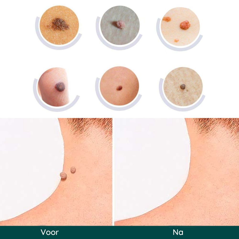 Skin Tag Remover Patches | Verwijder gemakkelijk en effectief irriterende huidlabels-Boetiek Moda
